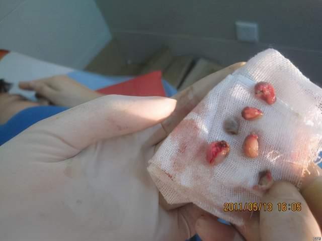 痔核照片,直观呈现痔疮形态与特征