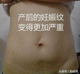 有妊娠纹的女明星